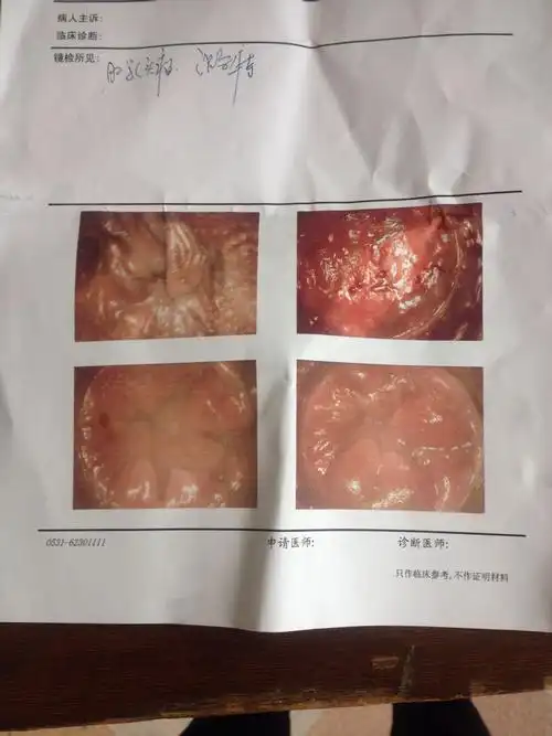 我女生25岁,我肛门里有两个乳头瘤请专家帮我看看结果我好害怕做手术