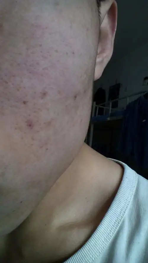 脸上这些小坑坑是怎么形成的该怎么去掉,最好是不手术的.