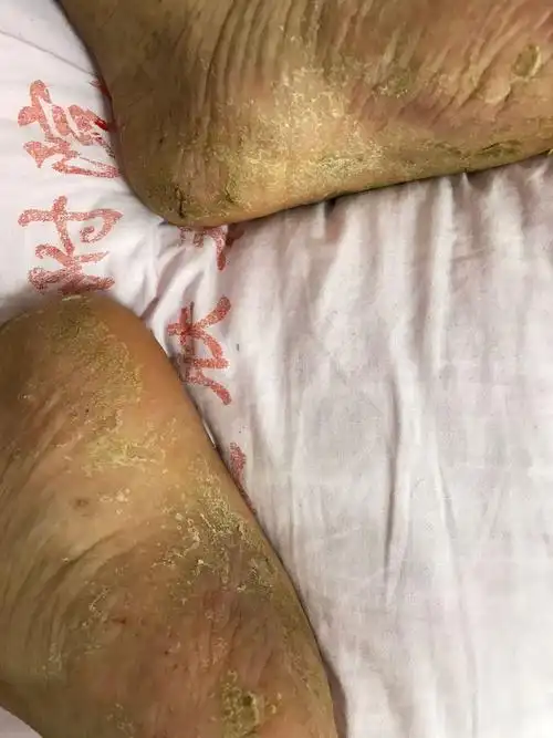 一组手足癣病