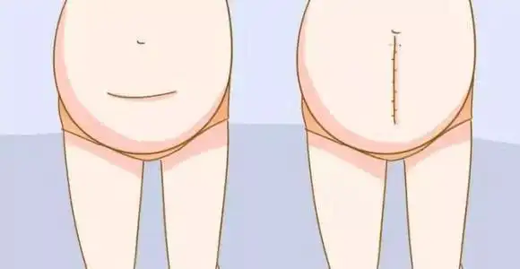 剖腹产,横竖都是一刀?有区别吗?