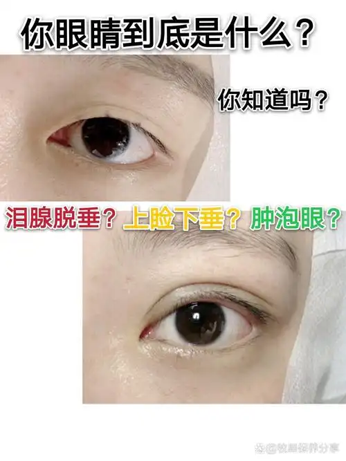 双侧泪腺脱垂=上睑下垂or肿泡眼7171