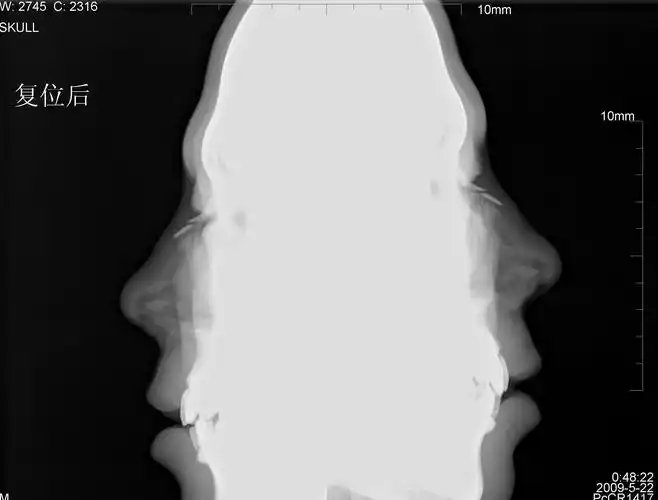 x光片  凡士林  做什么