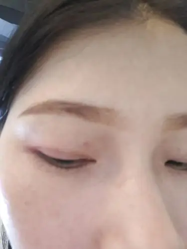 眼皮上长红色血块是什么情况?