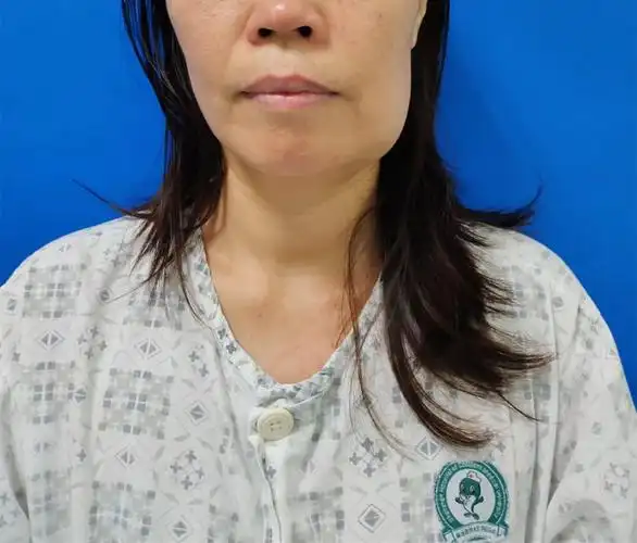 深圳一女子下颌骨里长肿瘤,医生10小时切除重建_读创客户端