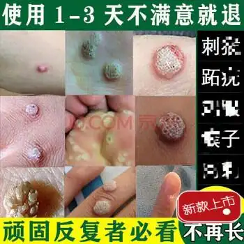官方旗舰必治一抹灵必治病毒疣凸刺疣治净手上膏神器的除猴子肉粒疙瘩
