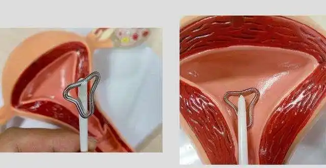 佩戴节育环的女性到了这个年龄尽量取出别图省事