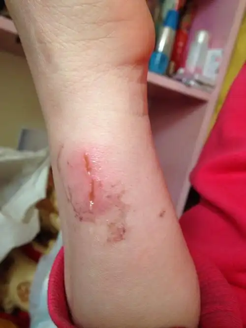 用指甲抓破胳膊会留疤吗?