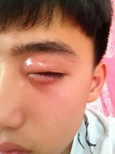 了病情而已,这要考虑发生眼睑蜂窝组织炎的可能,或者是过敏性眼睑炎