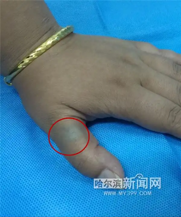 手背血管瘤(圆圈内)
