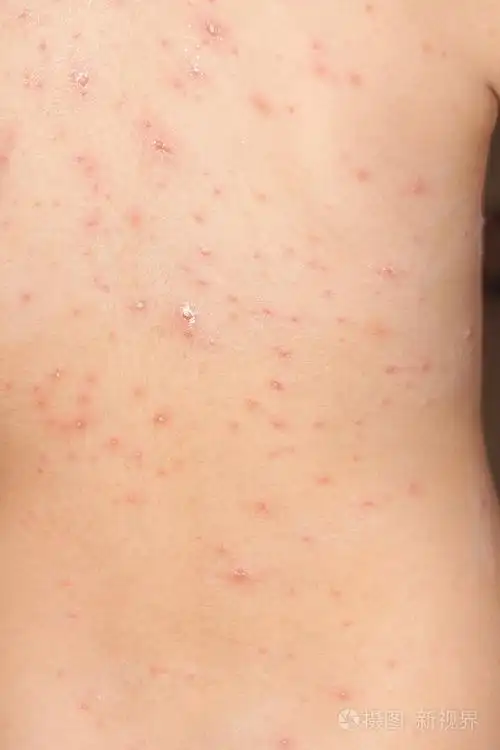 详细说明与水痘皮疹的孩子