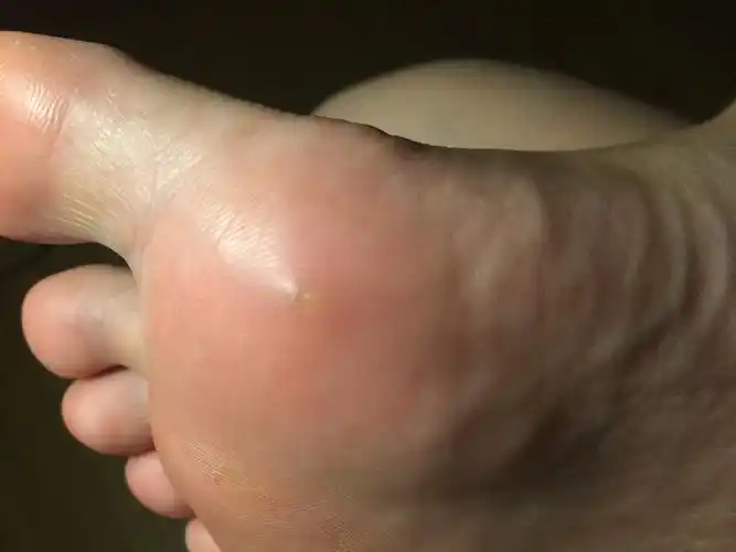 前几天脚底长了个透明的疙瘩,按下去痛的,这是什么啊?怎么弄掉它?