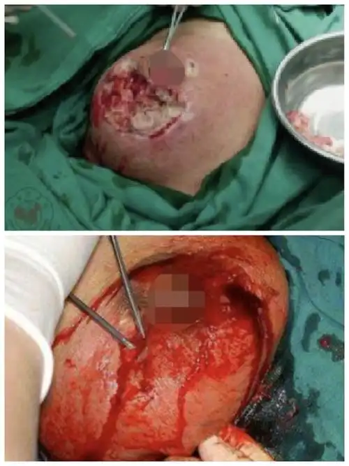 其它 乳腺炎,莫惊慌,我们为你保驾护航 写美篇  急性乳腺炎是乳腺的