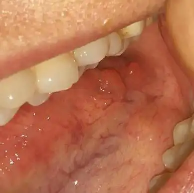 舌根左侧有两个水泡一样东西,不痛,但有异物感.有慢性咽炎多年.