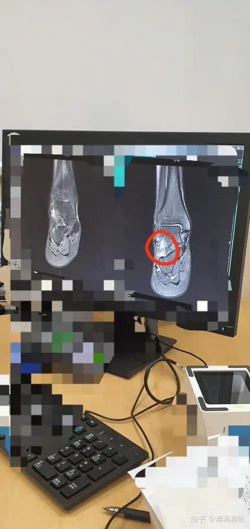 右踝距腓前韧带断裂大家如何治疗的