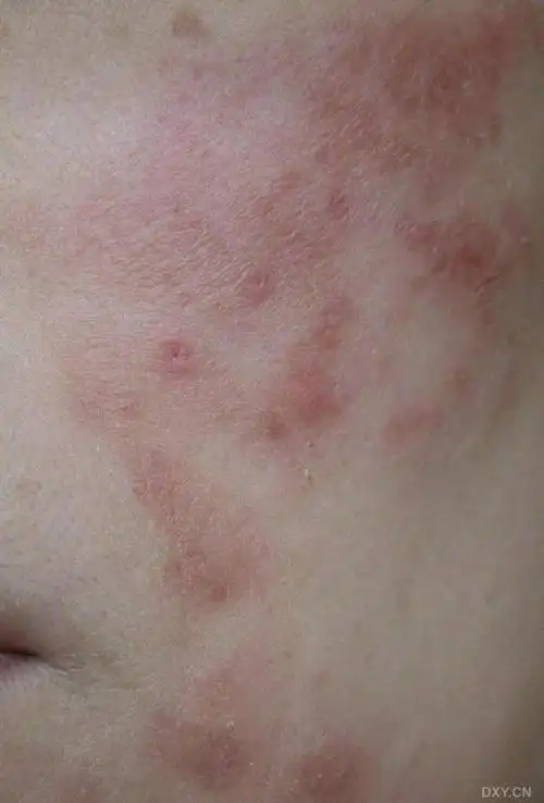 真菌感染?附图 [病例帖]