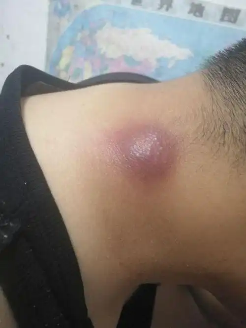 排脓前敌军布阵图问大夫要不要打麻药住院啥的,大夫说住院要核酸,太