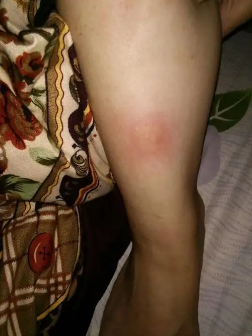 我脚被什么虫子咬了好痒.