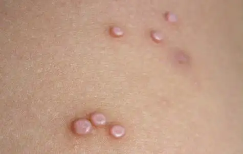 消疣散治寻常疣有奇效验方秘方