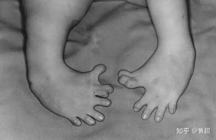 有许多产下的婴儿患有一种很罕见的畸形症状——海豹肢症,四肢发育不