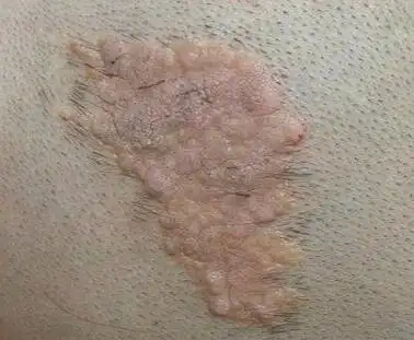 图5 皮脂腺痣 (图片摘自杨希川教授的文章)