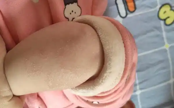 婴儿屁股上长尿布疹和湿疹的案例图片上有哪些区别? - 四明妇幼