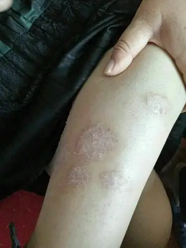 陈女士牛皮癣好转案例