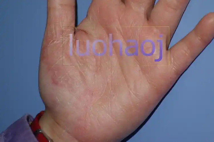 女孩手掌心掌跖角皮症5年余
