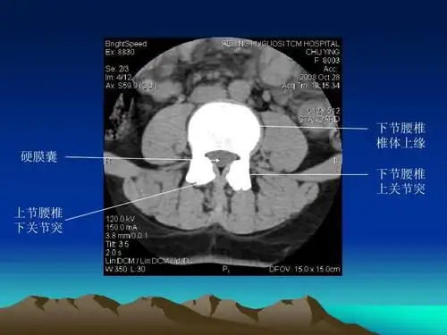 腰椎ct诊断ppt