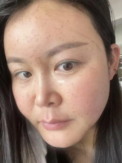 皮秒第七天,是不是感觉比前几天好多了,好几天没洗头了,我都快憋疯了