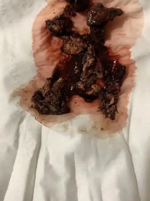 去yy花冤枉钱治不好,用了它们后排出很多垃圾毒素炎症没了妇科病完全