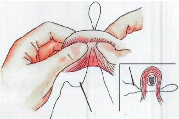 2,如果是女性结扎是结扎输卵管,输卵管是精子卵子结合的通道,结扎就是