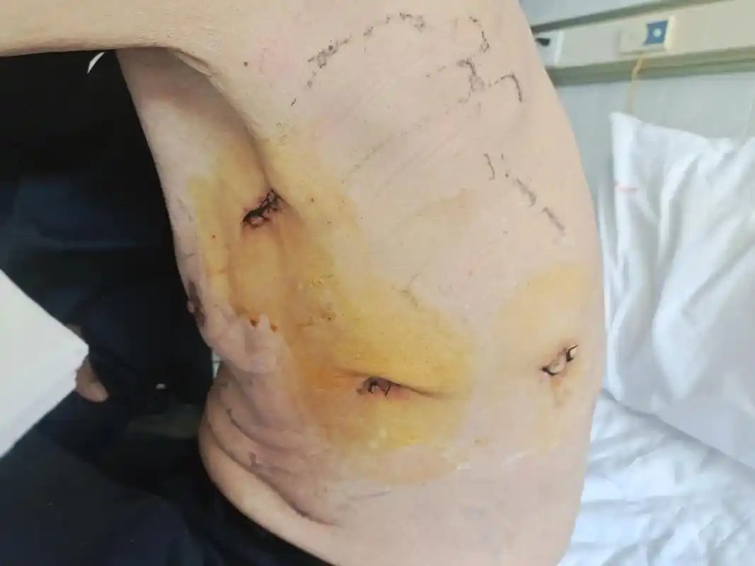 男性患者左上肺鳞癌胸腔镜手术后恢复良好