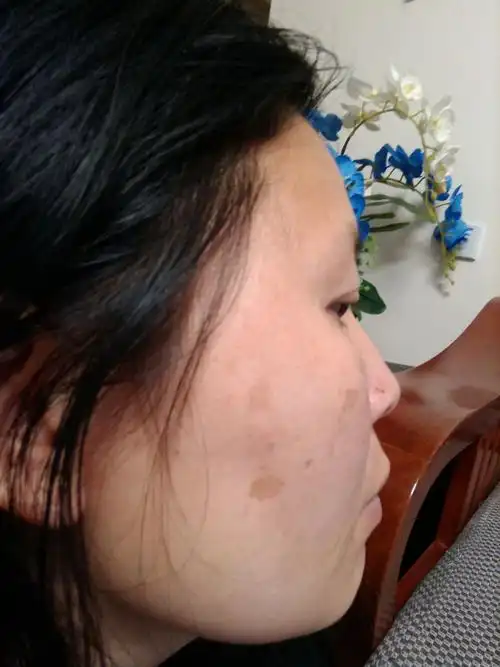 这是什么斑?能治么