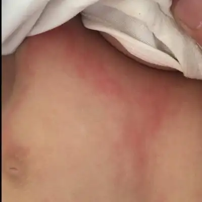 宝宝突然身上长了红色一块一块的疹子,是突然长出过一会又会下去的