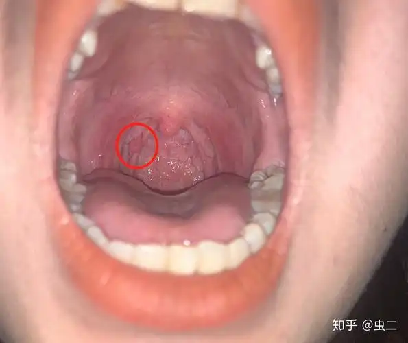 嗓子不舒服了就拿手机闪光灯照着喉咙对着镜子观察一旦有红血丝红肿