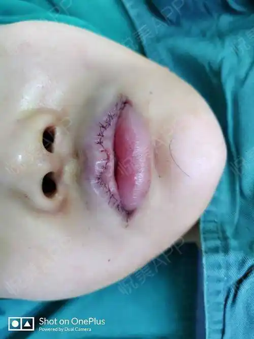 我是想了很久才决定去做的唇形改造,之前一直对嘴巴不是很满意,我又是