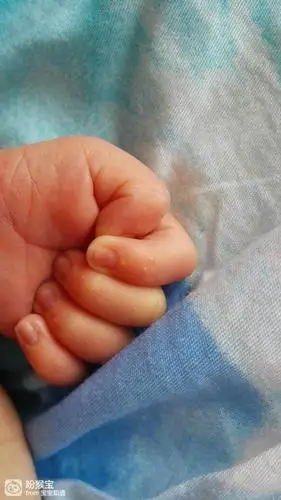 请问一下,宝宝手指上这白点是什么呀?宝宝9天了,每个手指上都有