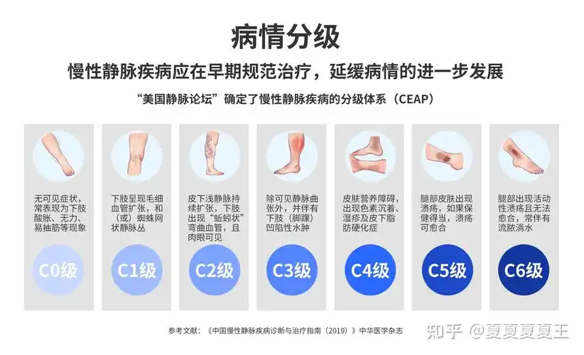 得了静脉曲张,会选择穿静脉曲张袜治疗吗?