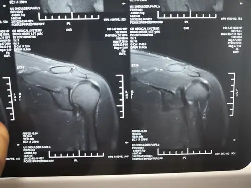 肩峰下滑囊炎_滑囊炎_症状_手术_康复 - 好大夫在线