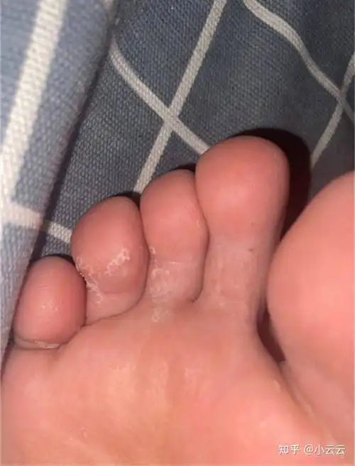 女孩子有脚臭脚气怎么办一个小技巧轻松搞定