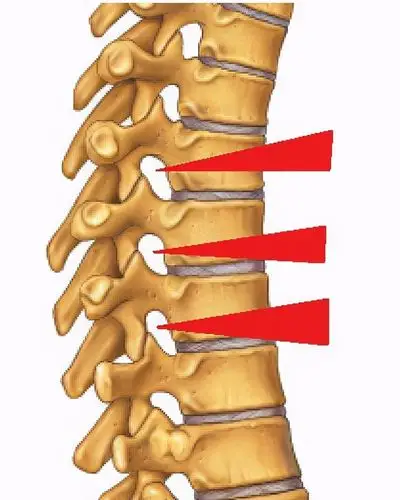 手麻,是不是都是颈椎病引起的?今天来认识一下另一个元凶