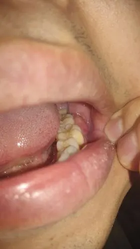 牙龈肿了,怎么治