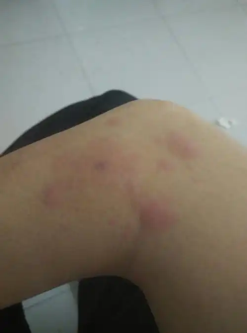 抹过蒜,毒霸药膏,还有一种和眼药水一样的治虫咬的.不知怎么这两天形