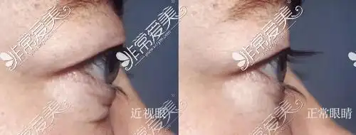 眼球外凸侧面照