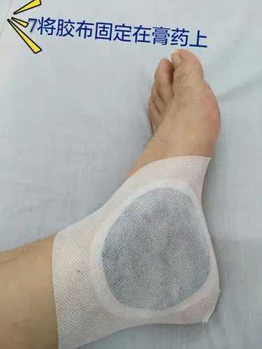 膏药贴敷体位与治疗点