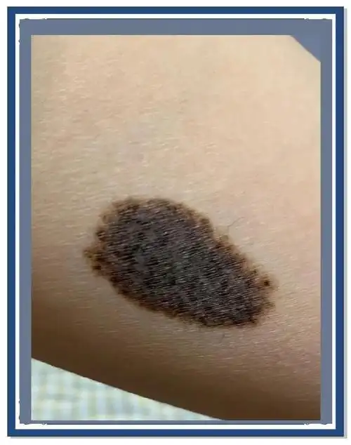 黑色胎记,也被称为先天性色素痣,通常在出生时或出生后不久被发现