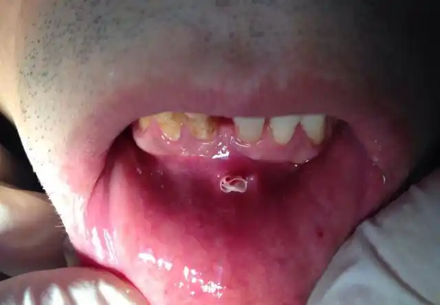 根尖囊肿的快速治疗