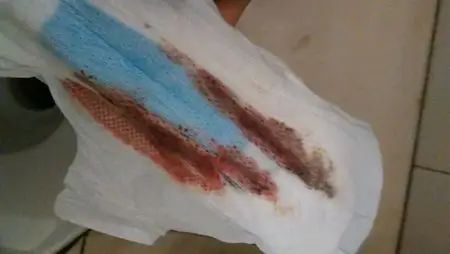 大多数母体没有特别明显的反应,少数女性会一些红色或粉红色的血迹,这