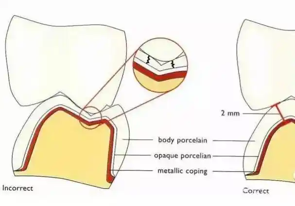 牙医备牙常常忽视了这些导致失败修复体的因素!