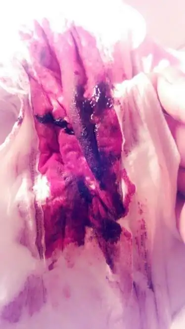 巧囊手术38天后,第一天来月经颜色是咖啡色的也像褐色的,根本不像月经